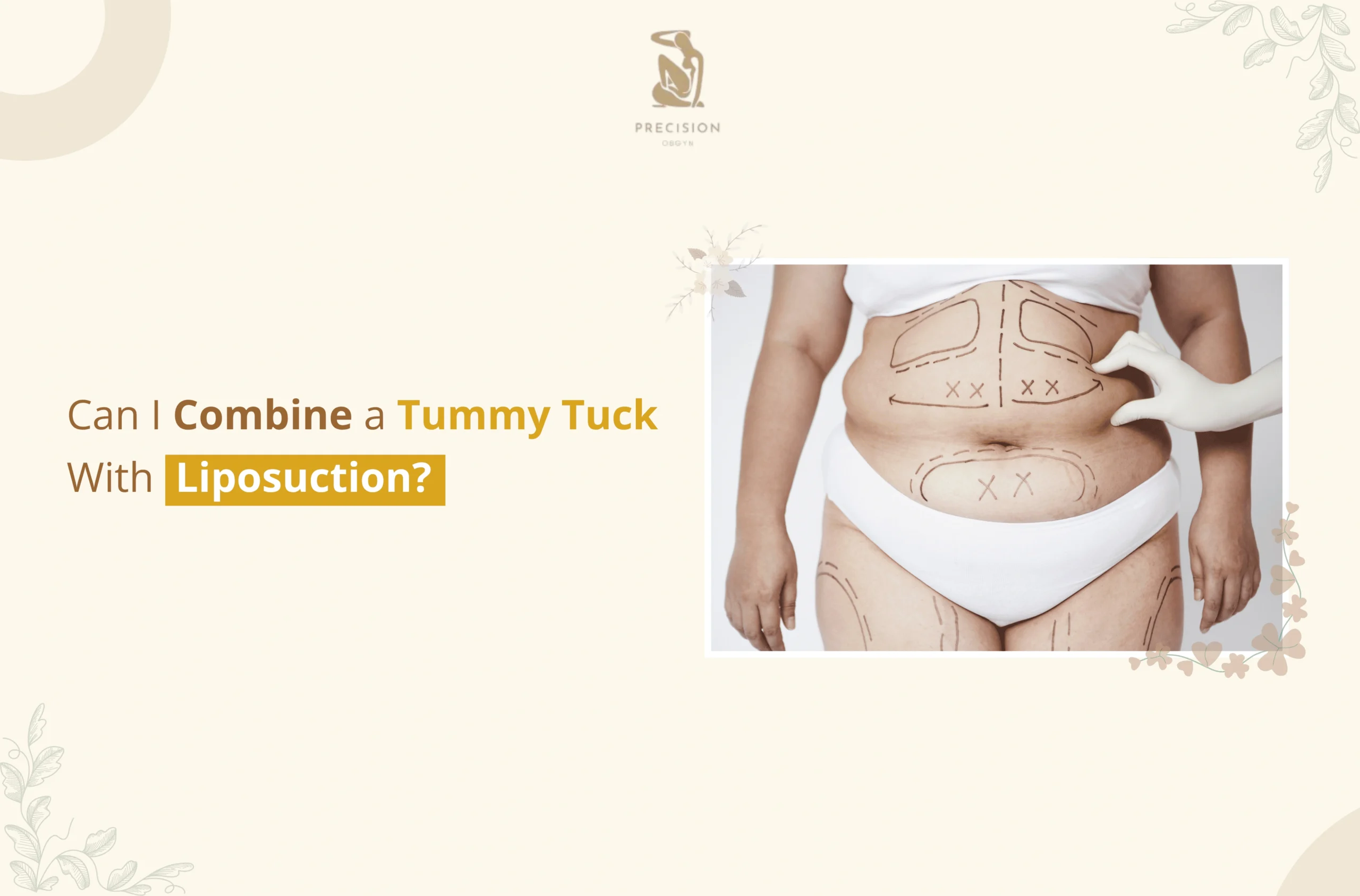 an I Combine a Tummy Tuck With Liposuction